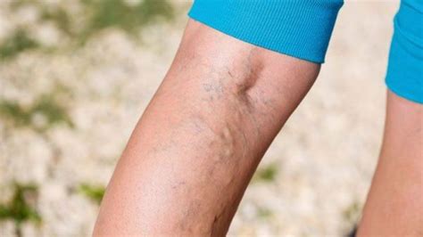cum se examinează picioarele cu vene varicoase pentru obstrucție